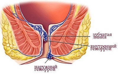 Народная медицина лечение геморроя