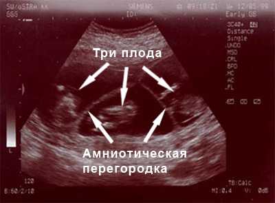 Плод 13 недель развития. Тяжи на УЗИ при беременности. Амниотическая полость на УЗИ.