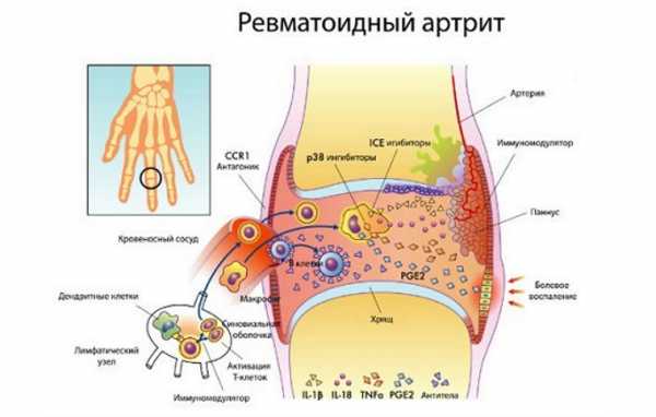 Что такое ревматоидный артрит как его лечить