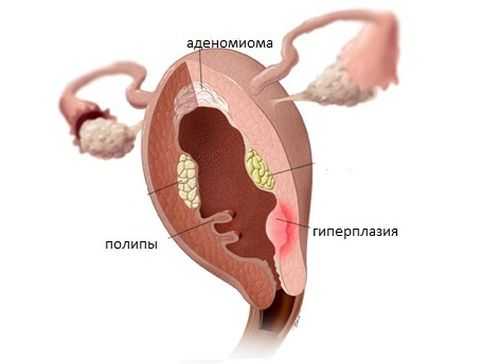 Гиперплазия эндометрия причины возникновения