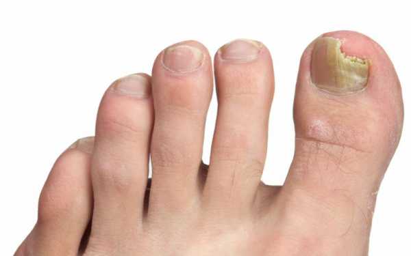Грибок ногтей на ногах чем лечить эффективно