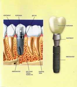 Имплант зубной из чего состоит