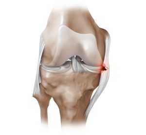 Острая боль в коленном суставе причины и лечение
