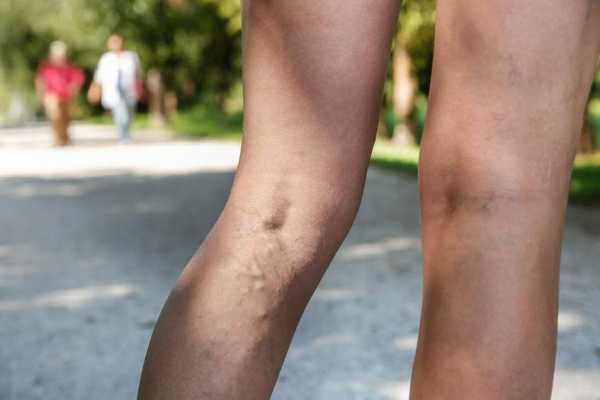 Причины боли в ногах у женщин