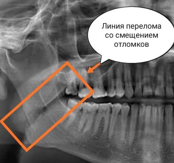Трещина зажила. Перелом нижней челюсти рентген. Перелом нижней челюсти без смещения рентген. Ангулярный перелом челюсти. Перелом нижней челюсти со смещением рентген.